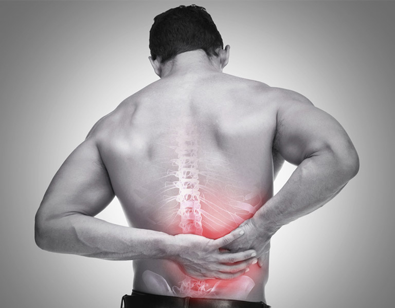 Đau vùng thắt lưng là triệu chứng phổ biến của bệnh thoát vị đĩa đệm L5 S1