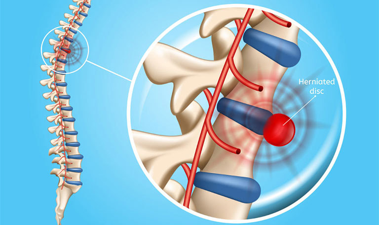 Thoát vị đĩa đệm ảnh hưởng trực tiếp đến sức khỏe, sinh hoạt, có thể gây ra biến chứng nguy hiểm