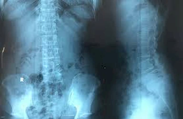 X-quang là phương pháp chẩn đoán phổ biến