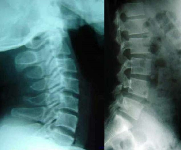 Bác sĩ chụp X -  quang cột sống thắt lưng để xác định vị trí đốt sống bị tổn thương