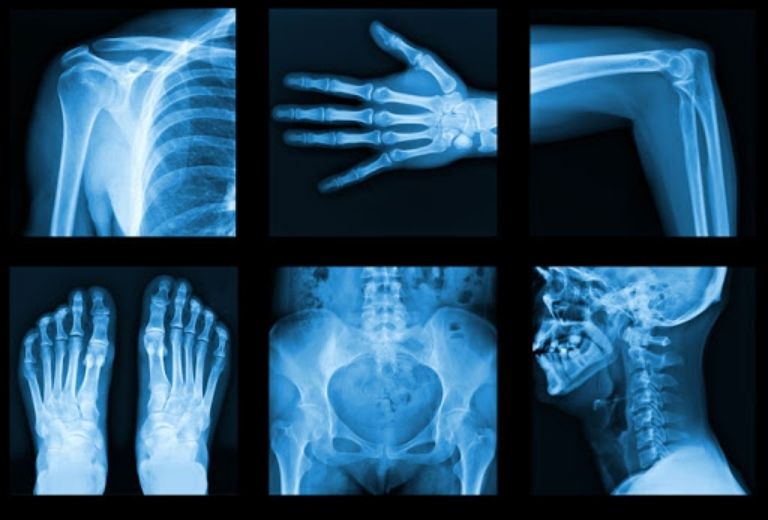 Chụp X - quang chẩn đoán viêm khớp