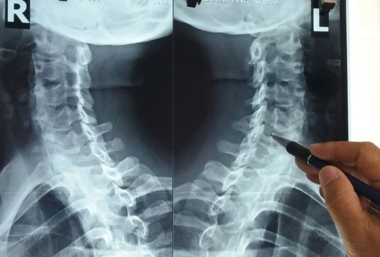 Phương pháp chụp X - quang chẩn đoán gai cột sống