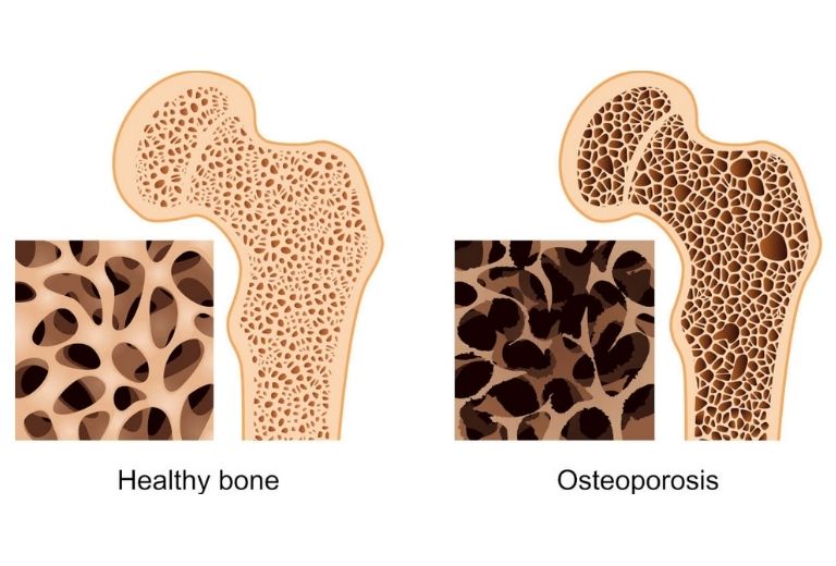 Đo loãng xương là tiêu chuẩn vàng để phát hiện bệnh loãng xương