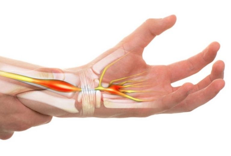 Hội chứng ống cổ tay khiến dịch khớp phần cổ tay tiết ra nhiều hơn
