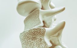 Bệnh loãng xương - bệnh lý xương khớp tiềm ẩn nhiều nguy hiểm