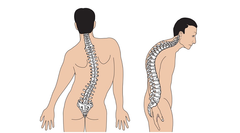 Vẹo cột sống là biến chứng điển hình cho câu hỏi thoái hóa cột sống lưng có nguy hiểm không