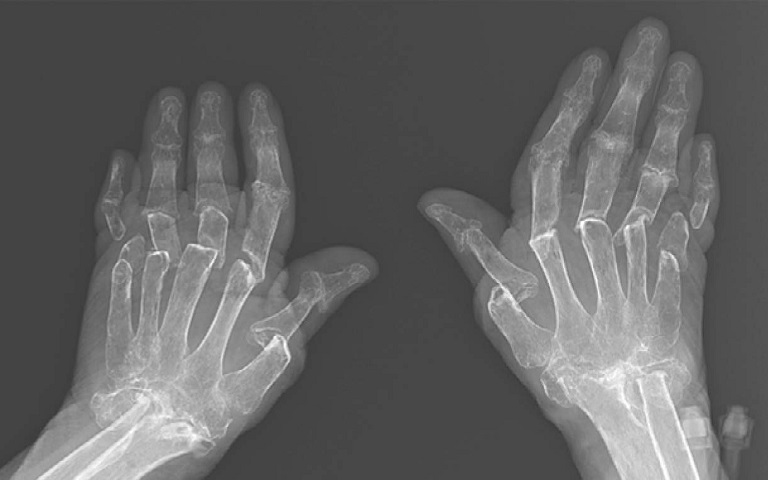 Các kỹ thuật chẩn đoán giúp xác định rõ nguyên nhân và mức độ tổn thương khớp tay. 