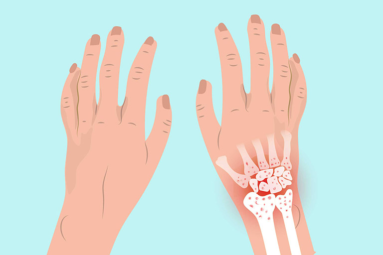 Tình trạng đau cổ tay có thể do một số bệnh lý xương khớp gây ra