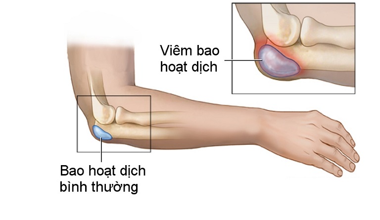 Viêm bao hoạt dịch là một trong những bệnh lý gây nên tình trạng viêm nhiễm khớp khuỷu tay.
