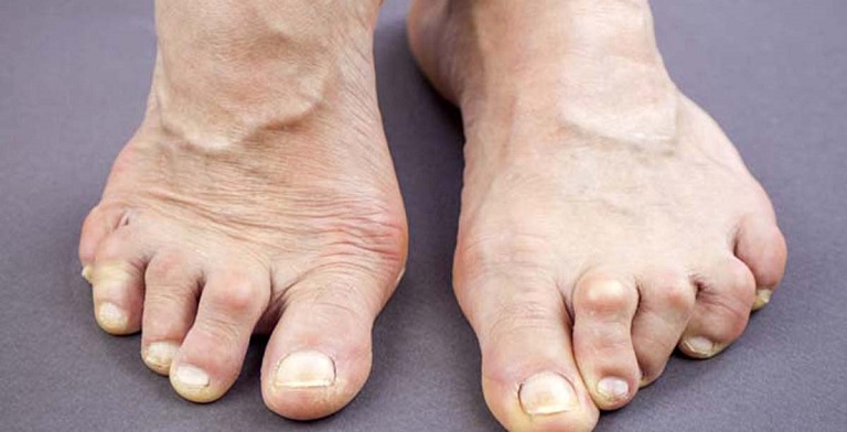 Bệnh có thể đi kèm một số triệu chứng khác như sưng đau, nóng ran, cứng khớp hay biến dạng ngón chân. 