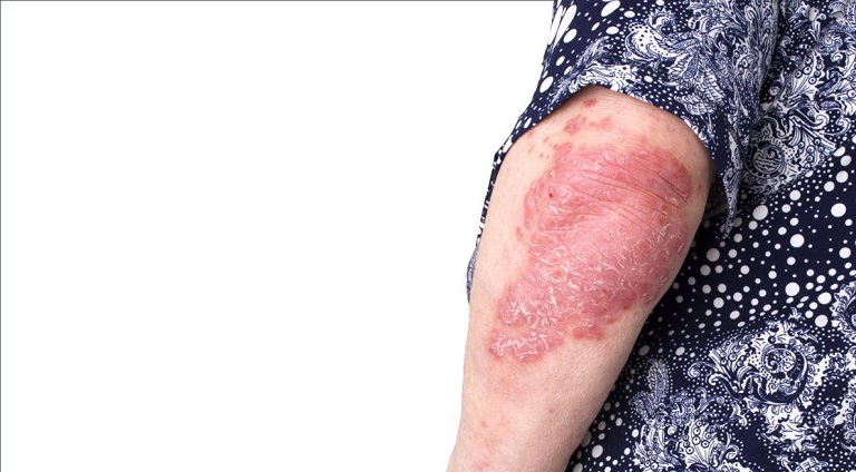 Triệu chứng điển hình là cảm giác đau khớp kèm sưng, ưng đỏ và bong tróc vảy trắng trên bề mặt da. 