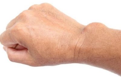 Viêm bao hoạt dịch khớp cổ tay: Dấu hiệu và cách điều trị hiệu quả