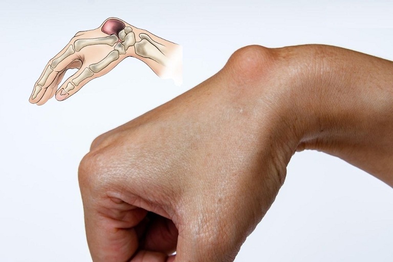 Viêm bao hoạt dịch khớp cổ tay thường tự khỏi nhưng nhiều người hợp có thể gây nguy hiểm đến sức khỏe