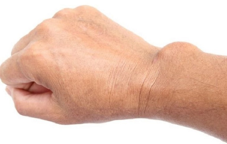 Viêm bao hoạt dịch khớp cổ tay: Dấu hiệu và cách điều trị hiệu quả