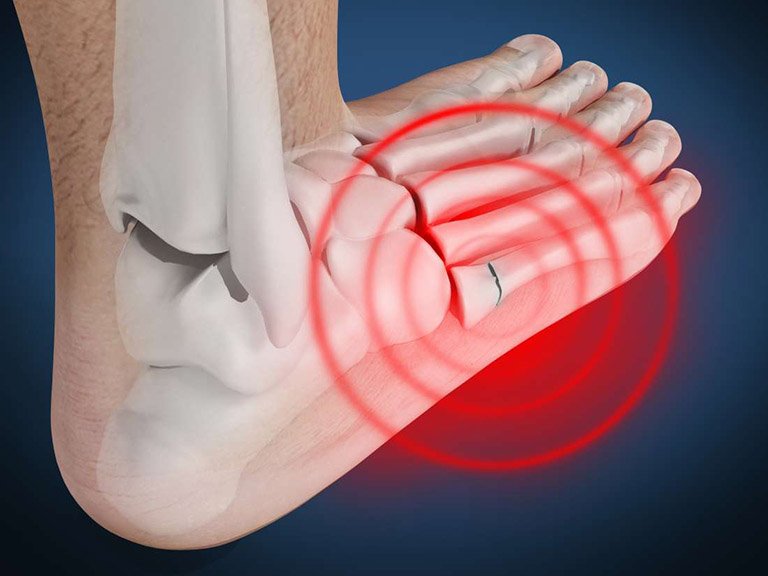 Bệnh viêm khớp bàn chân: Hình ảnh, dấu hiệu và hướng điều trị hiệu quả