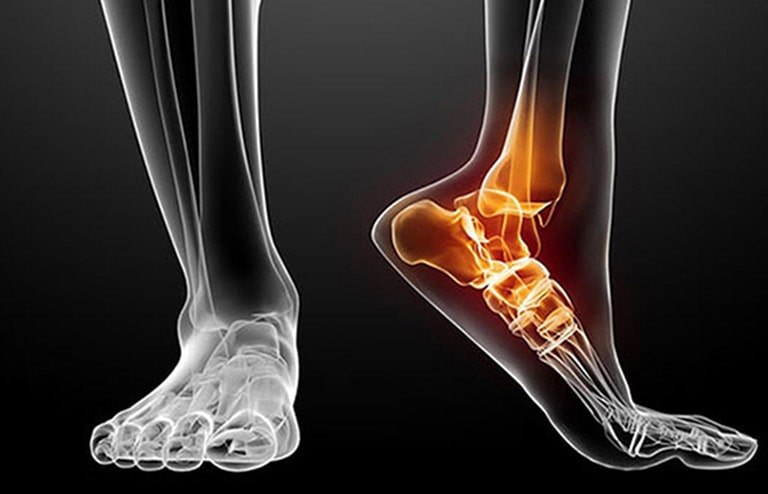 Bệnh thoái hoá khớp cổ chân nếu để kéo dài sẽ dẫn tới teo cơ