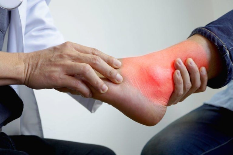 Sưng khớp cổ chân có thể là dấu hiệu của các bệnh lý về xương khớp