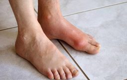 Viêm bao khớp cổ chân là gì? Triệu chứng và cách điều trị