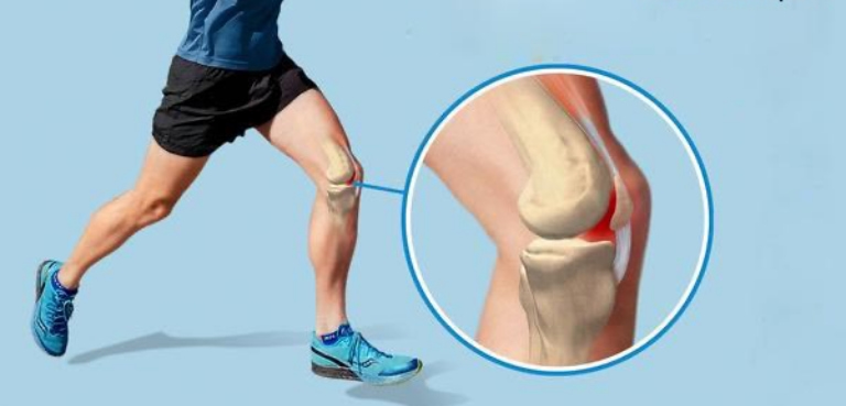 Đau khớp gối khi chạy bộ có thể là dấu hiệu của một số bệnh lý về xương khớp