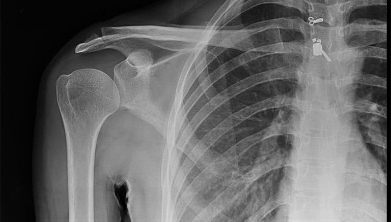 Chụp X-quang là một phương pháp giúp xác định tổn thương quanh khớp vai