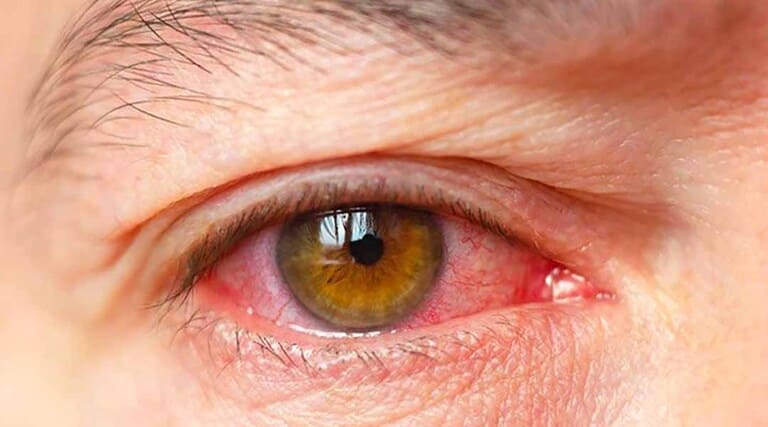 Viêm khớp dạng thấp ở trẻ em nếu không chữa trị kịp thời có thể gây ra viêm màng bồ đào ở mắt, rất nguy hiểm