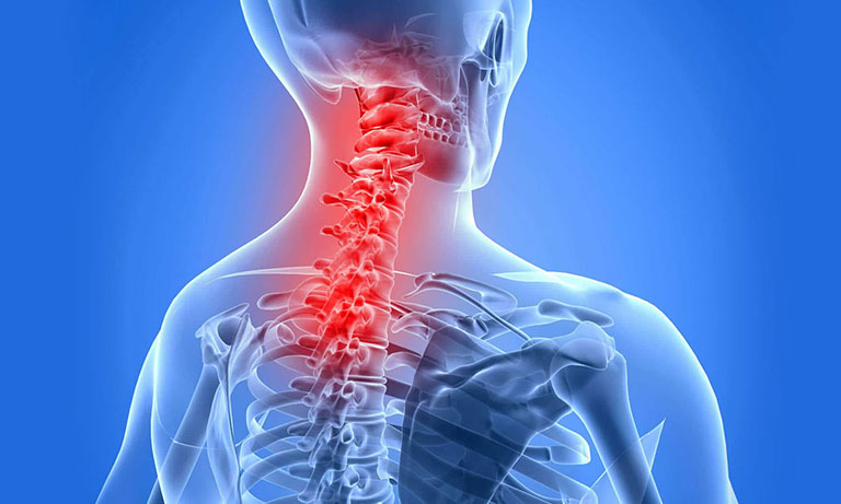 Gai đốt sống lưng L3 L4 L5 gây đau nhức vùng thắt lưng
